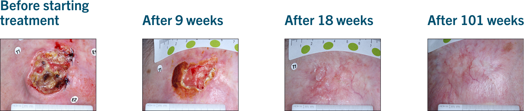 Patient examples from LIBTAYO® trials: Example 3 of patients with advanced BCC