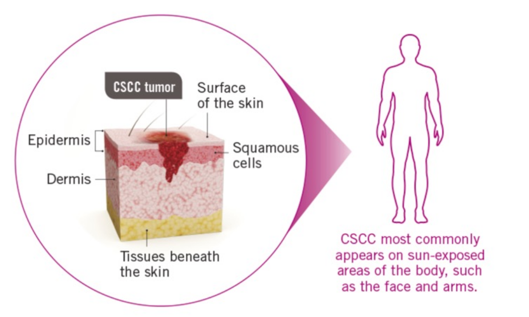 What is Advanced CSCC? | LIBTAYO® (cemiplimab-rwlc)