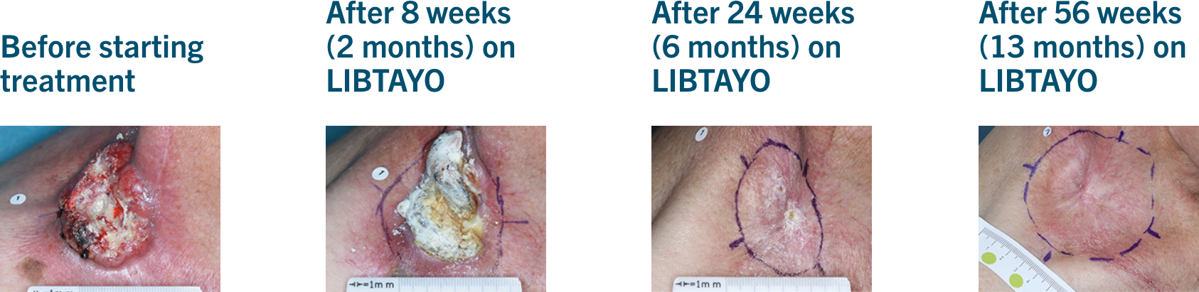 Taking LIBTAYO® (cemiplimab-rwlc) | Advanced CSCC
