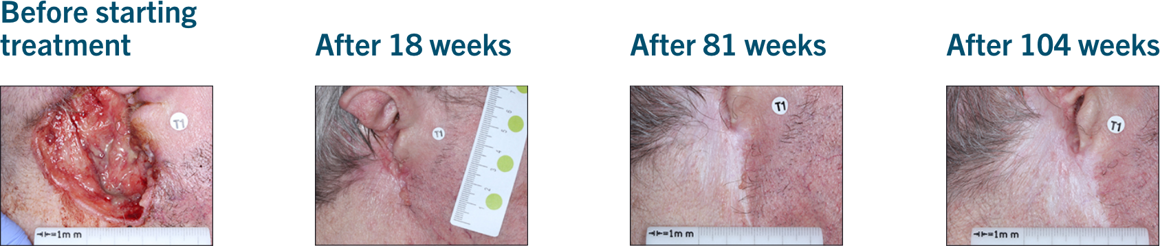 Patient examples from LIBTAYO® trials: Example 2 of patients with advanced BCC