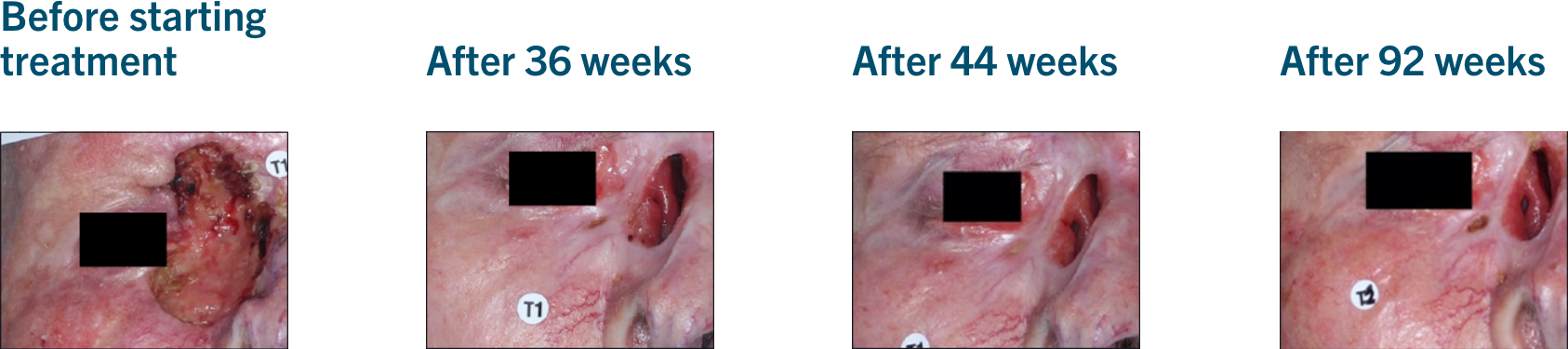 Patient examples from LIBTAYO® trials: Example 1 of patients with advanced BCC