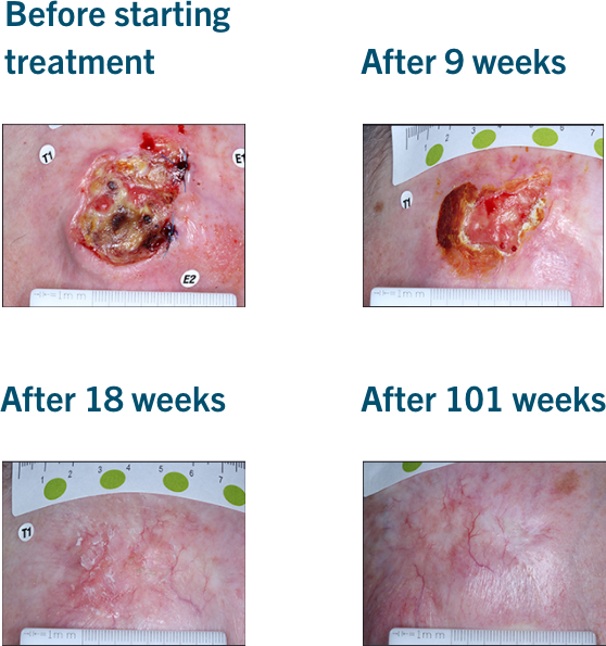 Patient examples from LIBTAYO® trials: Example 3 of patients with advanced BCC