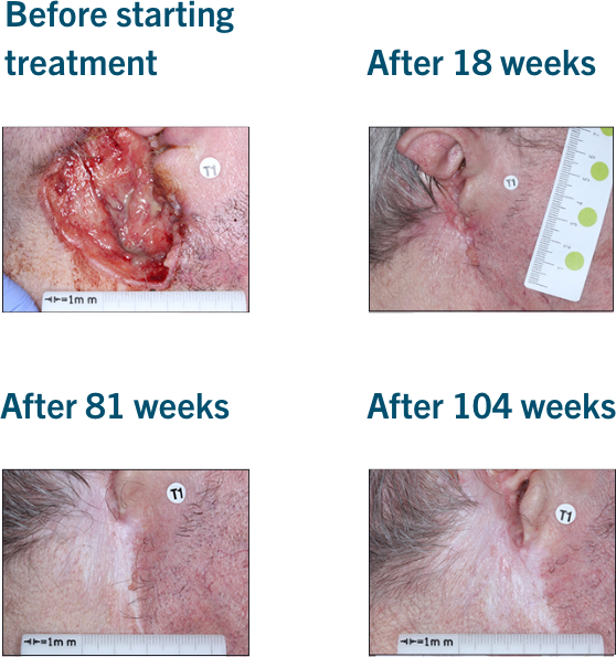 Patient examples from LIBTAYO® trials: Example 2 of patients with advanced BCC