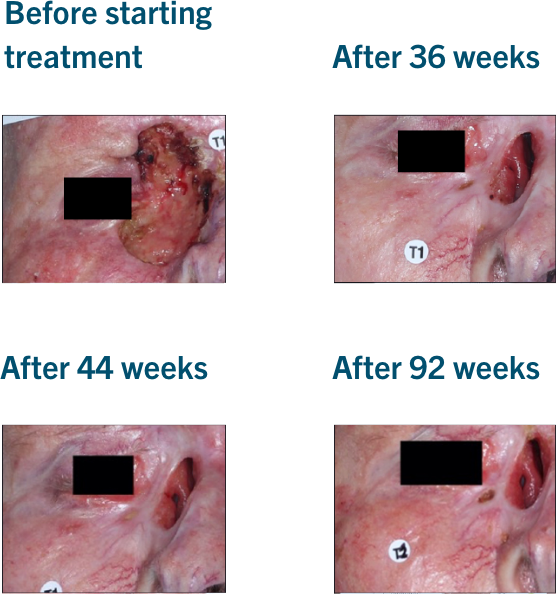 Patient examples from LIBTAYO® trials: Example 1 of patients with advanced BCC